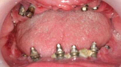 Actualización sobre enfermedades periimplantarias