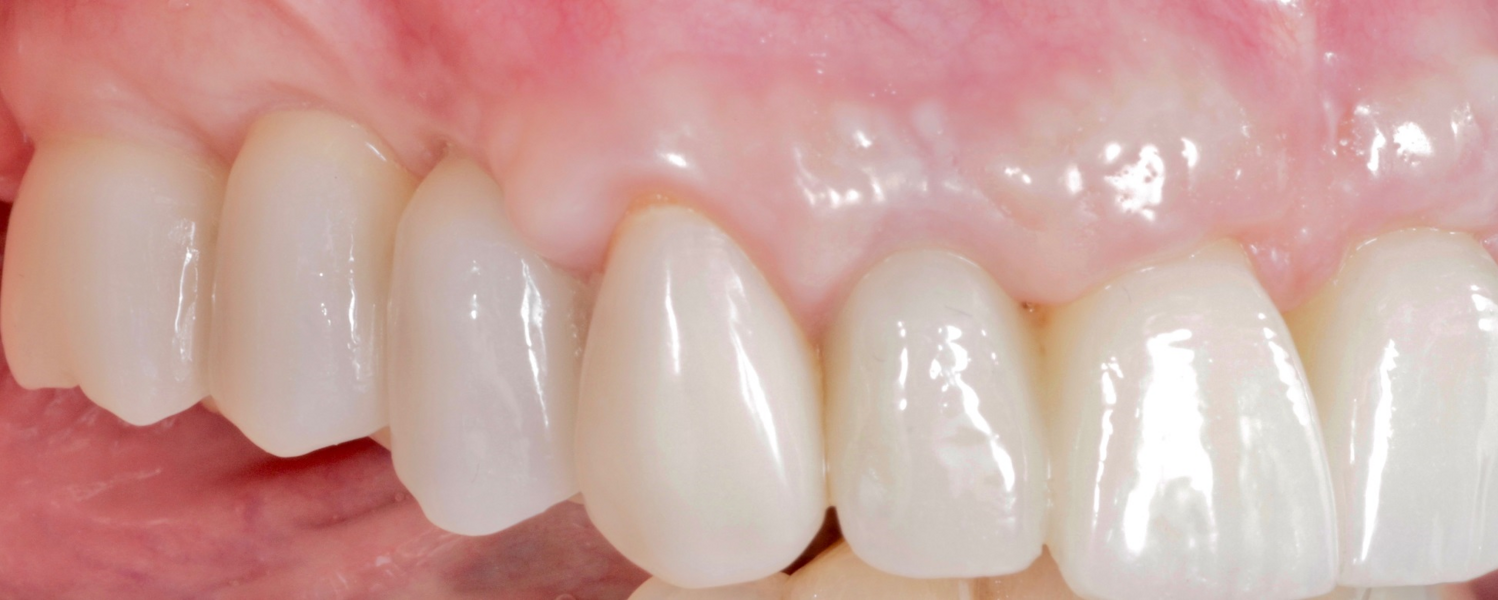 Fig. 15: Right lateral aspect of the restorations.