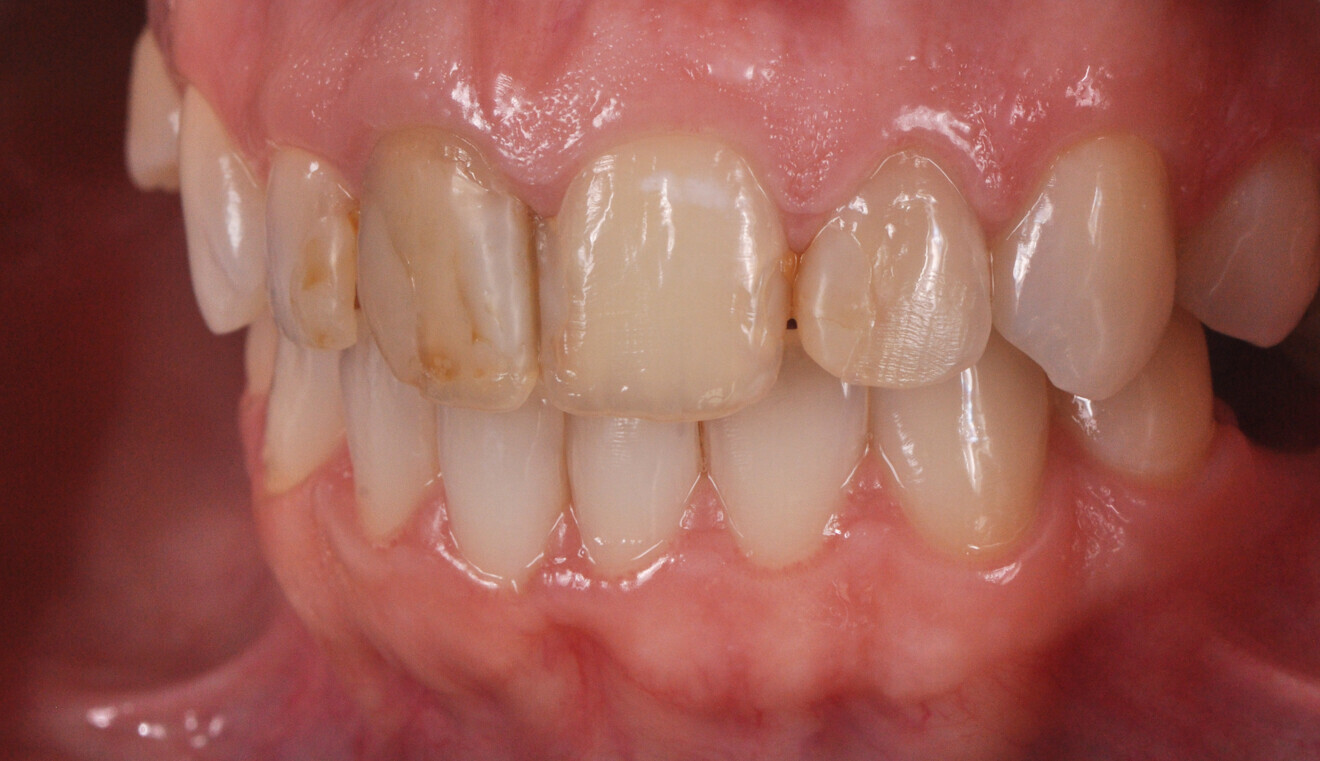 Fig. 3b: Restorations in need of replacement. Lateral view from the left (b).