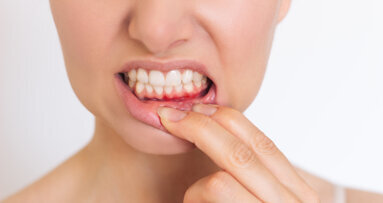 研究发现，牙周炎增加了年轻人中风的风险