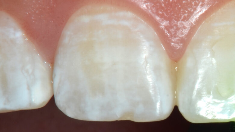 Foto 4. Diente 11, se observan manchas blancas en toda la superficie vestibular.
