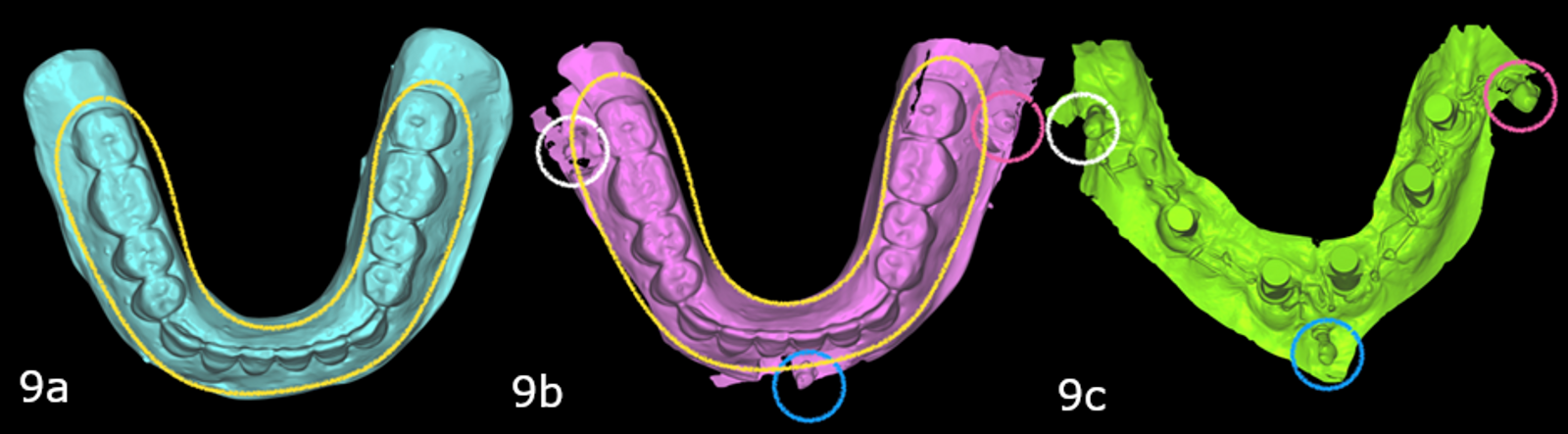 Figs. 9a–c: Scan of the mandibular trial prosthesis (a). Scan of the trial prosthesis with three TADs (one in the midline, two on the buccal shelf; b). Intra-oral scan of the five mandibular implants with the three TADs (c).