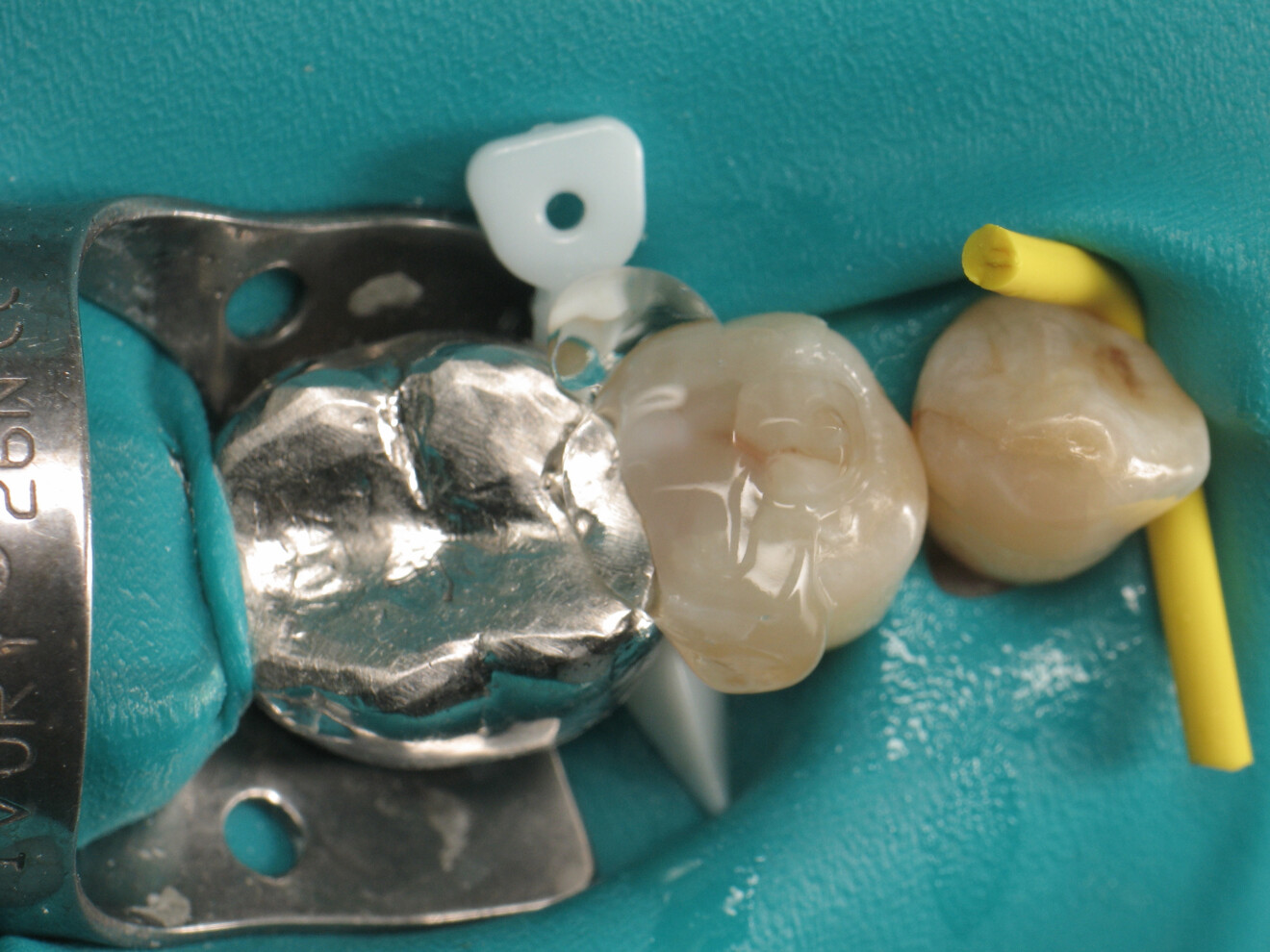 Fig. 17: Isolation of the restoration with glycerine.