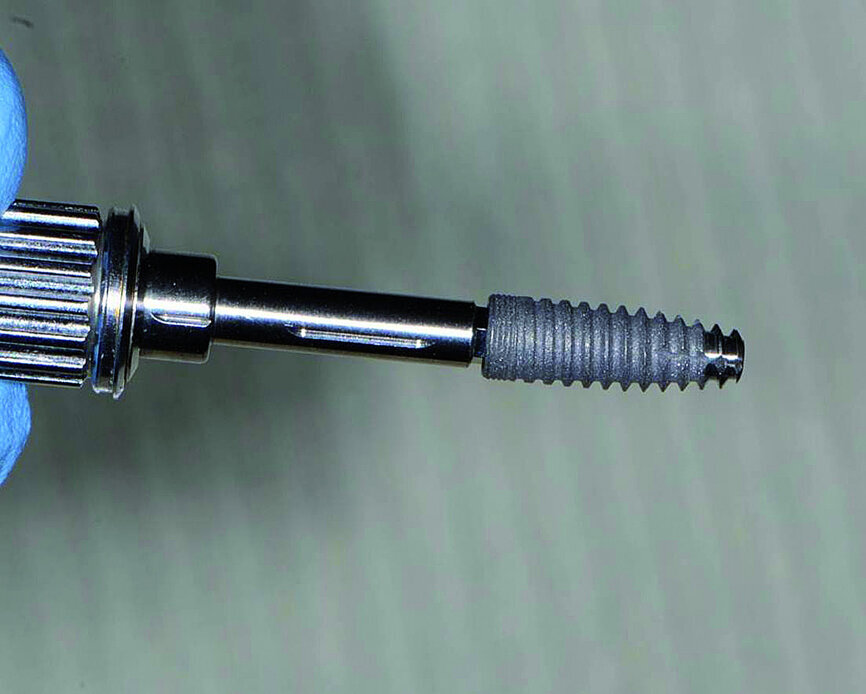 Fig. 5: Engage dental implant depicting the thread pattern and auger tip.