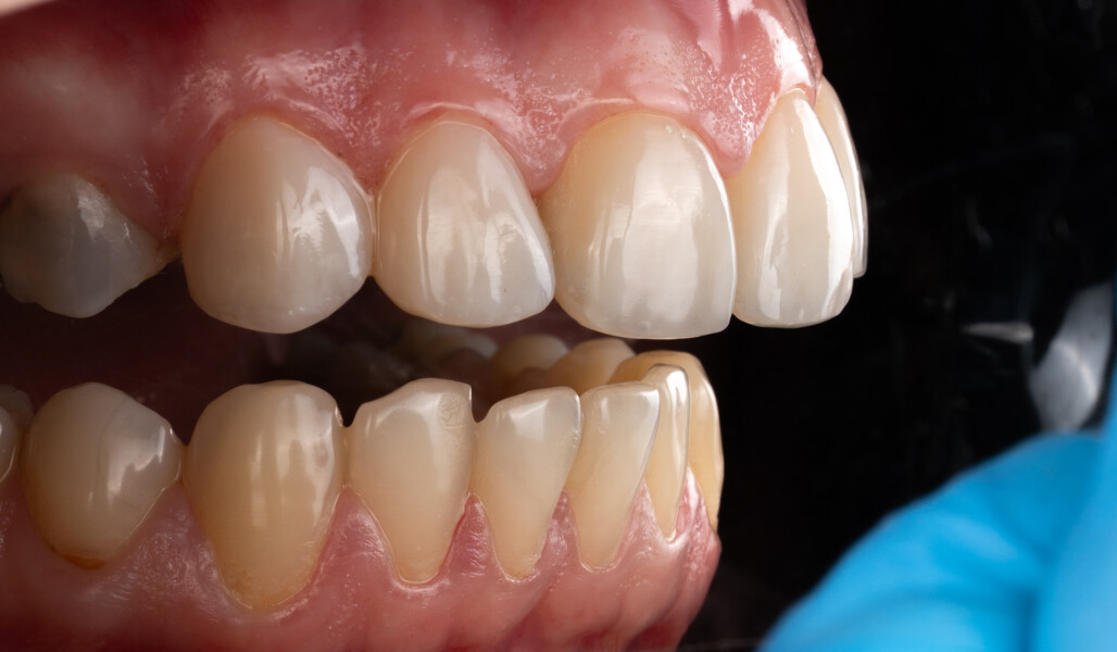Fig. 9c: Final treatment outcome. Intra-oral lateral view from the right.