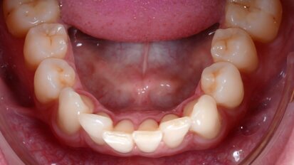 Accelerated aligners with photobiomodulation Accelerated aligners with photobiomodulation