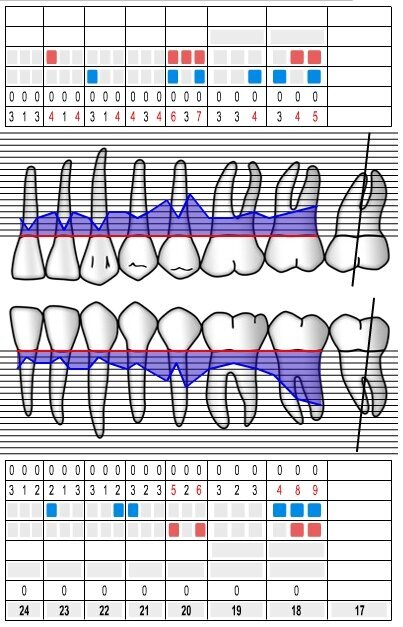 Fig. 3 - Sondaggi parodontali 3° quadrante.