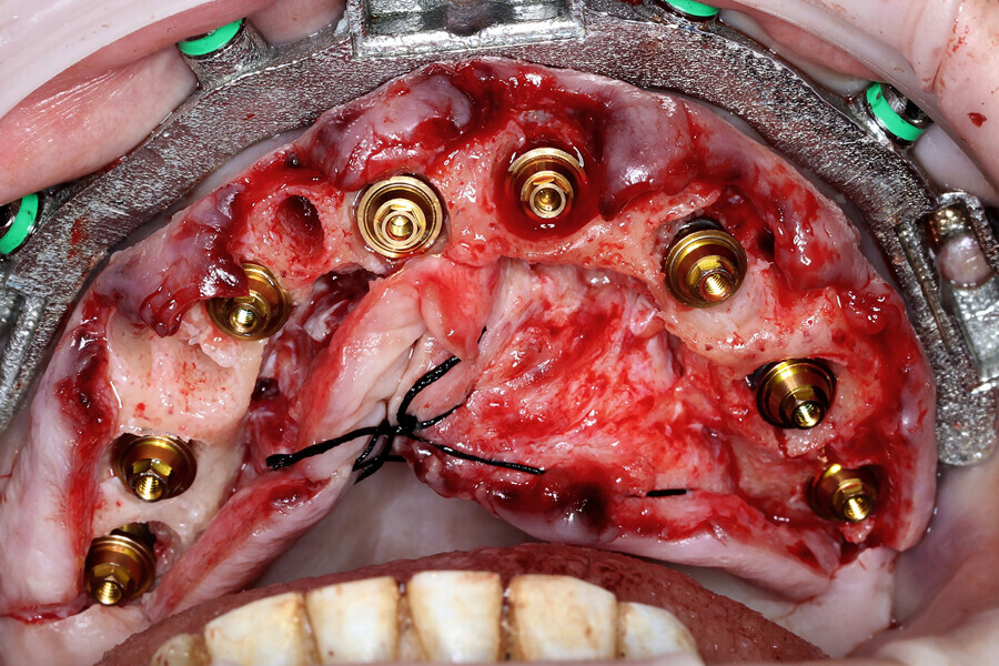 Fig. 5b: Multi-unit abutments seated on to the implants.