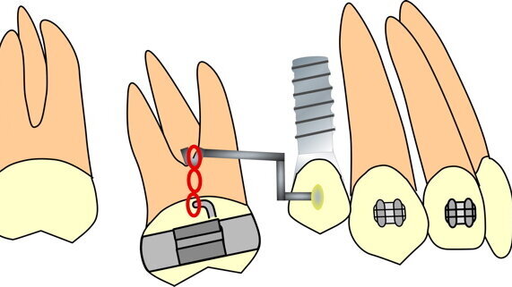 Biomechanics in the orthodontic treatment of complex multidisciplinary problems
