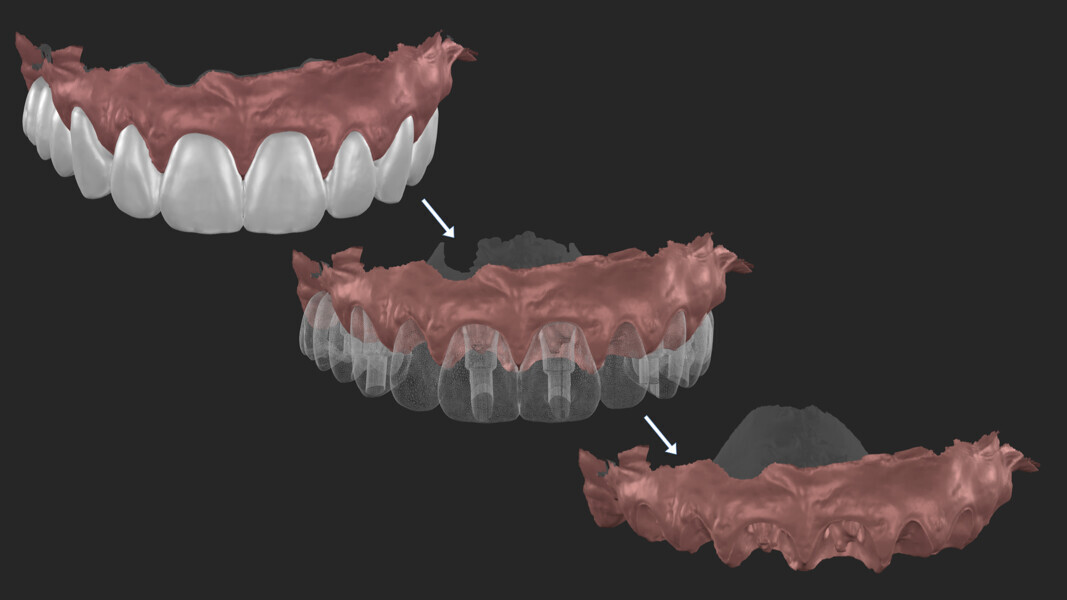 Fig. 31: Separating the tissue and the temporary restoration in the intra-oral scan.