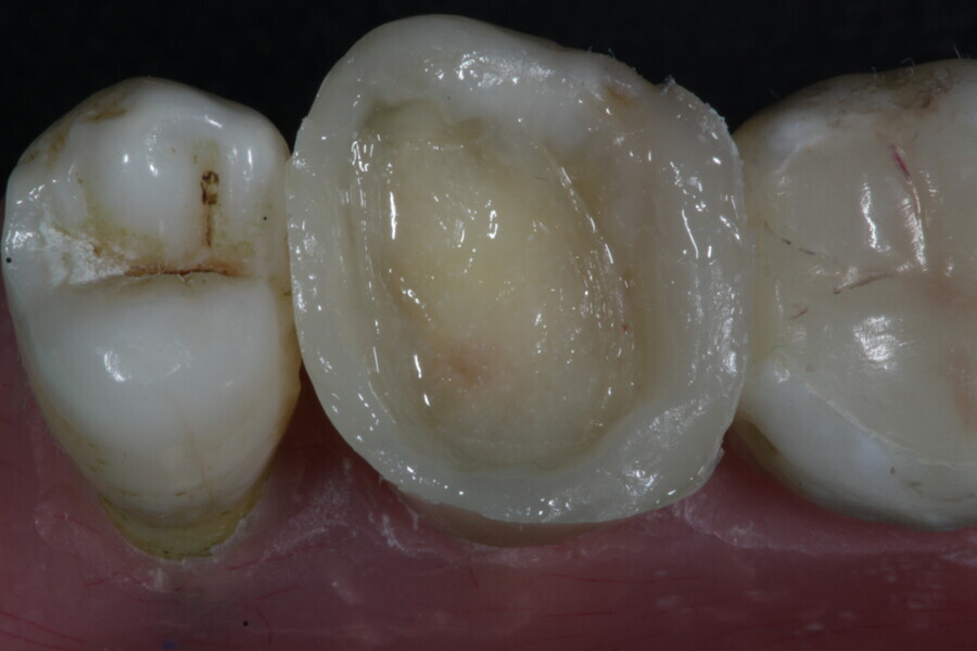 Fig. 41: A dose of fibre-reinforced membrane cube is applied into the cavity to protect the walls of the large cavity.