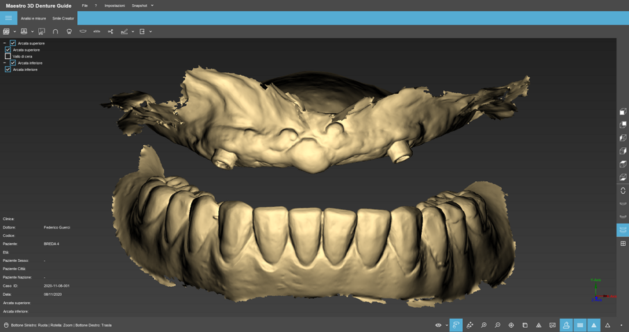 Fig. 12 - La D.V.O. si mantiene ovviamente anche togliendo la protesi superiore.