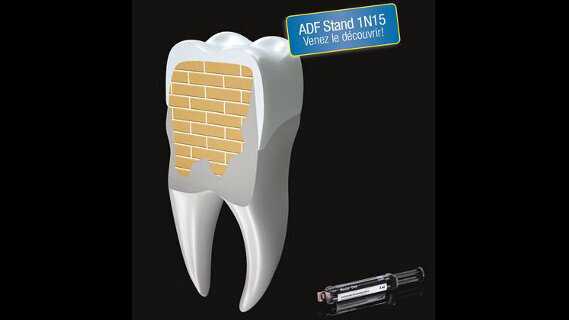 Nouvelle génération de matériaux pour reconstitution de moignons.