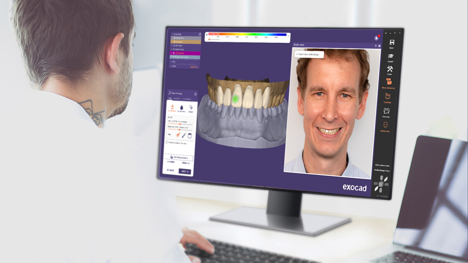 Smile Creator, exocad, digital dentistry, tooth shape