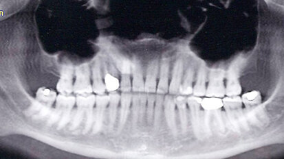 Terapia farmacologica durante blocco acuto dell’articolazione temporo-mandibolare