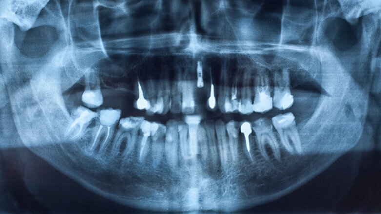 Menopause: Bisphosphonate begünstigen Verlust von Implantaten
