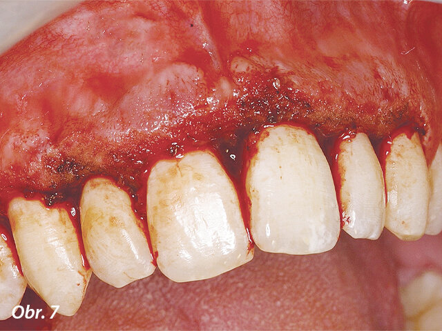 Po odstranění hyperplastických tkání v horním frontálním úseku byl patrný posun směrem k požadovaným výsledkům.