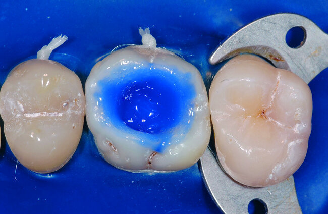 Fig. 18 : La dentine est mordancee a l’acide phosphorique pendant 15 secondes.