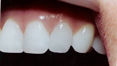 Μη επεμβατική αισθητική θεραπεία στο ετήσιο Βρετανικό Οδοντιατρικό Συνέδριο