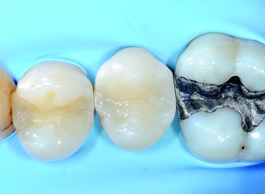 Situation after removing ring, matrix and wedge. Good position the matrix and the use of an adequate ring allows minimum interproximal finishing at the end of the stratification.