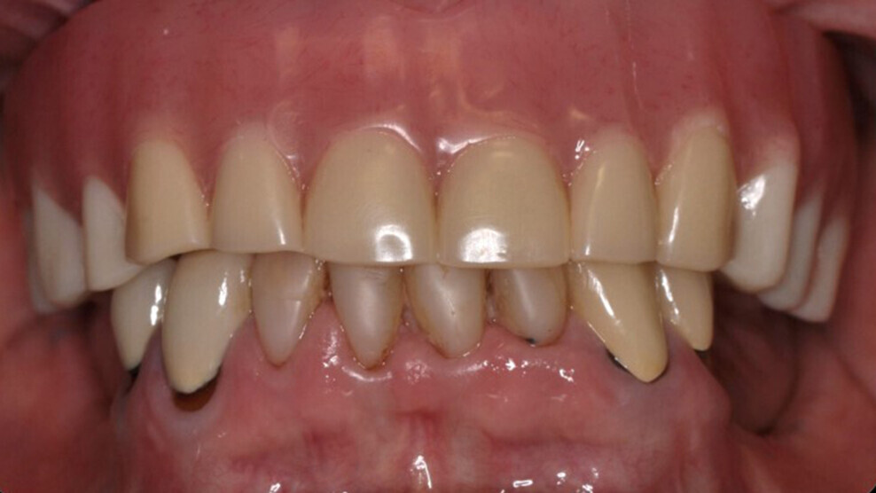 Fig. 19: Final implant-supported prosthesis.
