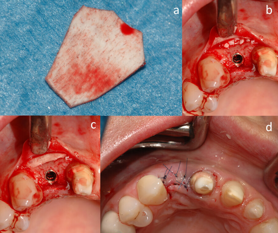 Fig. 3 - Posizionamento della membrana corticale (a) sotto al lembo vestibolare (b), riempimento con granuli ossei di derivazione equina (c) e chiusura del lembo (d).