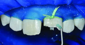 Kompozitni kočići ojačani vlaknima: jednostavno do pouzdanih nadogradnji