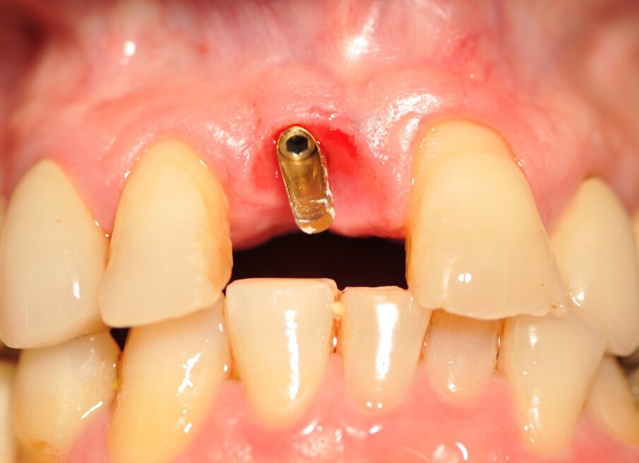 Fig. 9_Situazione clinica prima della cementazione della corona definitiva.