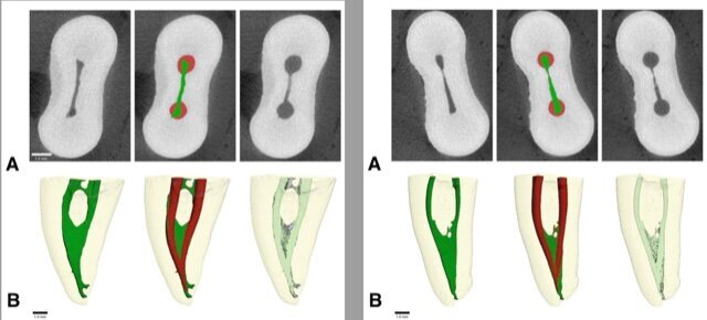 Wird dem Hypochlorit ein milder Entkalker (HEDP) beigegeben, werden die Ablagerung von einer Schmierschicht an den Kanalwänden und Débris in Kanalisthmen stark reduziert. Links, Mikrotomographien und 3D-Rekonstruktionen eines Kanalsystems, welches mit reinem Natriumhypochlorit (2,5%) gespült wurde, rechts die entsprechenden Bilder, wenn dieser Natriumhypochloritlösung 9% HEDP beigemischt wurde. © Matthias Zehnder