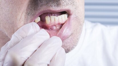 Middle-aged tooth loss linked to increased coronary heart disease risk Middle-aged tooth loss linked to increased coronary heart disease risk