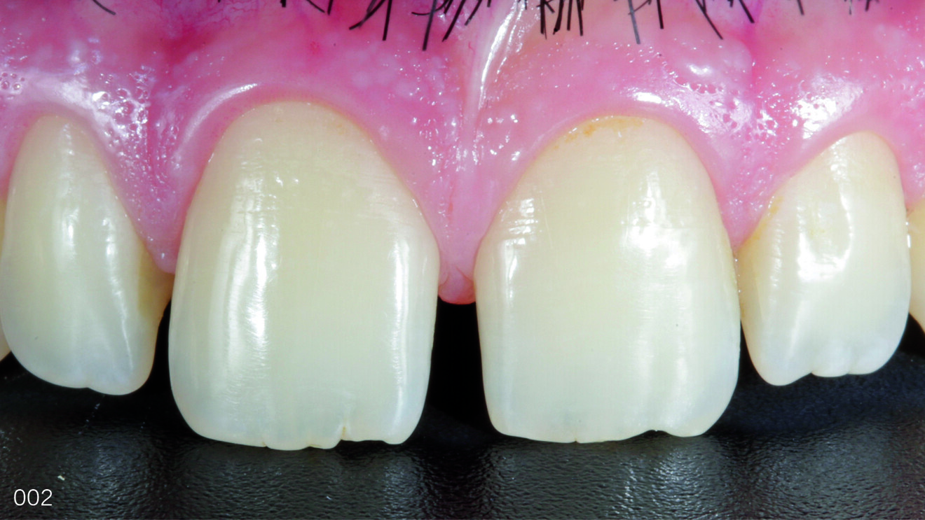 Fig. 2: Initial photograph showing a detail of the maxillary arch.