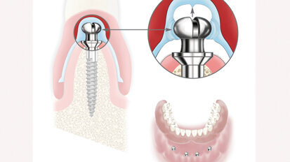 Atlas Denture Comfort secures new or existing dentures Atlas Denture Comfort secures new or existing dentures