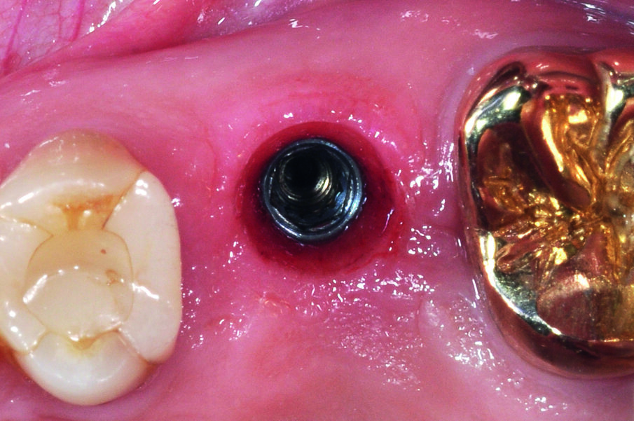 Fig. 13: The emergence profile after unscrewing the gingiva former.
