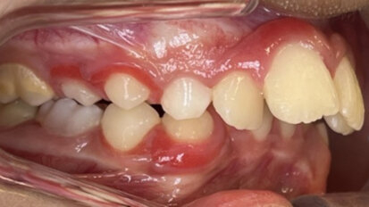 Interceptive aligner treatment in a growing Class II, Division 1 patient—a two-phase orthodontic approach using aligners and Class II elastics