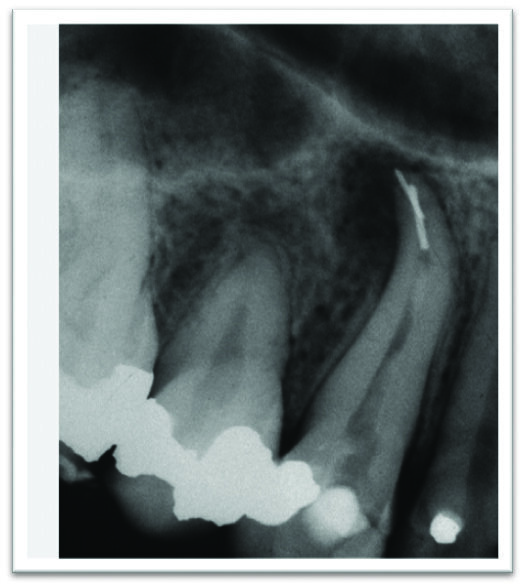Figure 1. Separation of a second instrument while attempting to remove the first separated instrument is not uncommon.