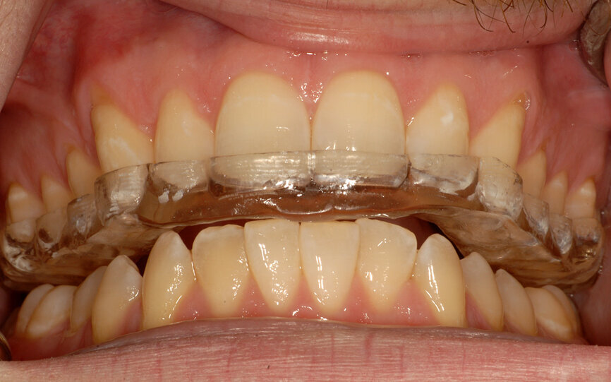 Fig. 10: A complete-coverage occlusal device to relax the muscles and heal the joints.