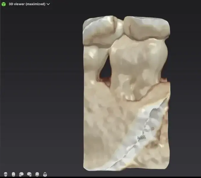 Фиг. 11а Костна реконструкция с DTX Studio Clinic, показваща костен дефект в коронарната област (а). Рентгенография непосредствено след обтурацията на кореновите канали, която показва запълване на латералните канали в коронарната част на дисталния канал (б).