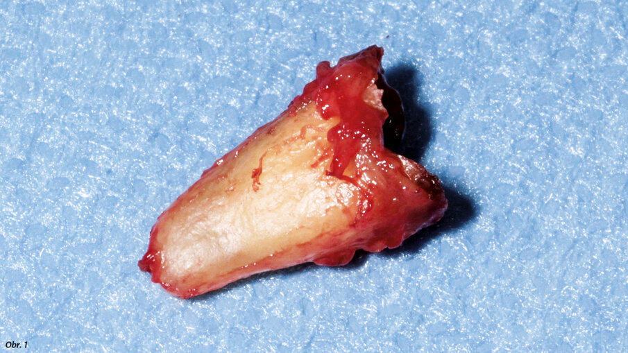 Extrahovaný kořen na radikulární štěp.