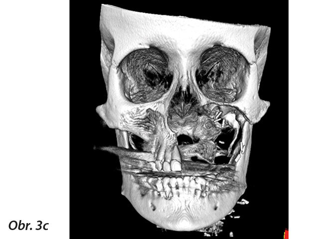 CBCT snímek.
