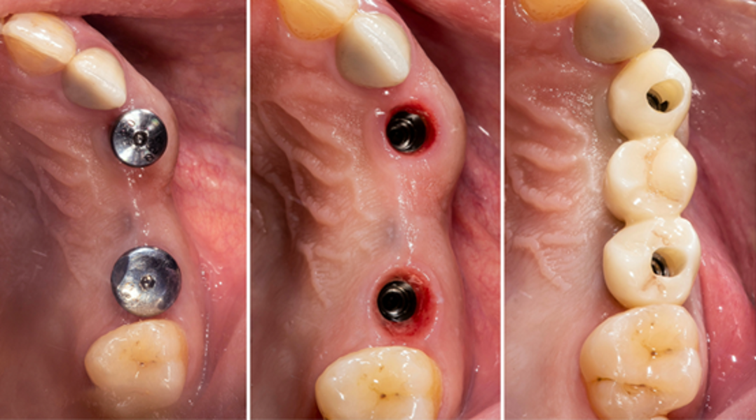 Fig. 13a-c: Implants with healing abutments (a). Emergence profiles, a few months after implantation (b). Final restoration in situ (c).