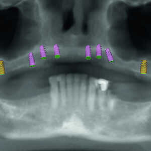 Fig-3-Présentation-du-traitement-de-l’arcade-maxillaire-300x300-
