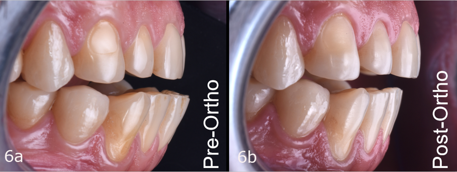 Figs. 6a & b: The situation pre- and post-orthodontic treatment.