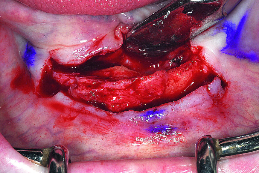 Fig. 13: A full thickness mucoperiosteal flap exposed the knifeedged ridge of the mandibular symphysis.