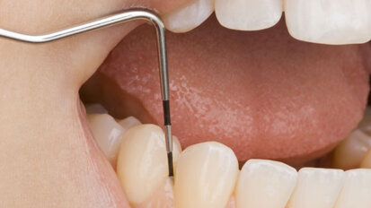 Kaum Behandlungsfehler bei Karies