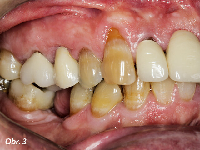 Intraorální laterální pohled v okluzi.