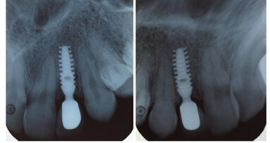 Отпаднаха лицензите за денталните секторни рентгени