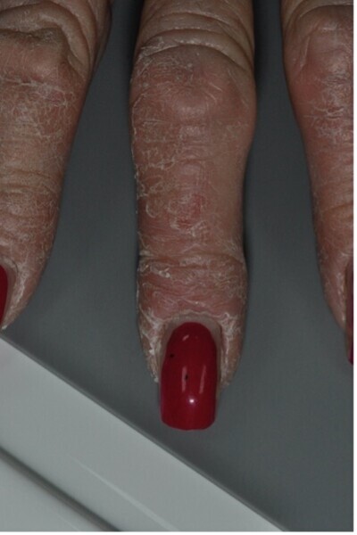 Fig. 3 : Manifestation cutanée idiopathique survenu chez cette patiente ayant bénéficié d’implant 4–5 ans auparavant. La patiente a commencé par perdre certains implants sans manifestation infectieuse majeure. Les signes dermatologiques se sont aggravés lors de la mise en place des piliers prothétiques.