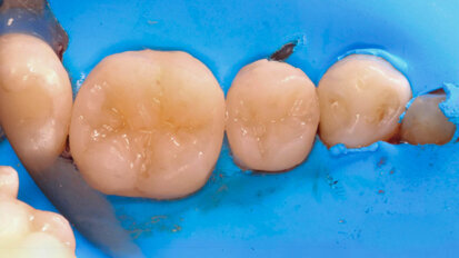 Fig. 4: Rubber fragments on the composite can be spread over the restoration surface using a fine nylon brush, polishing each fissure and pit.