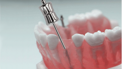 Nuevos extractores manuales para fragmentos de raíces