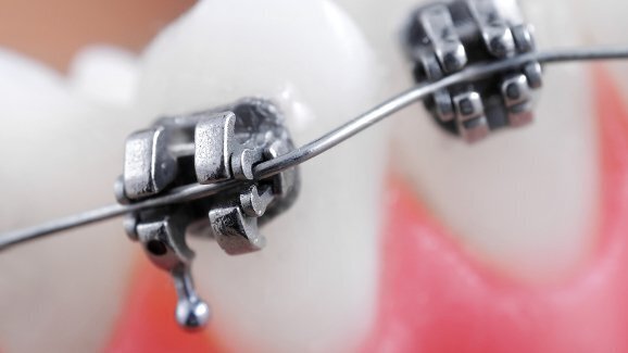 Xylitol heeft geen effect bij beugeldragers